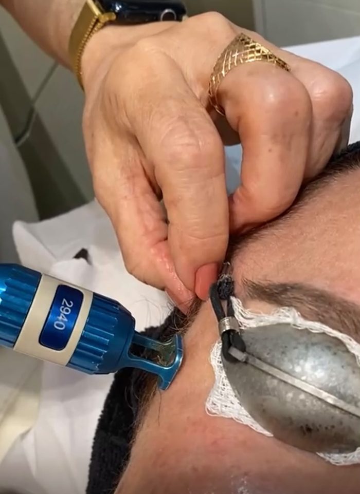 Aplicação de procedimento pela Dra. Graça Abreu